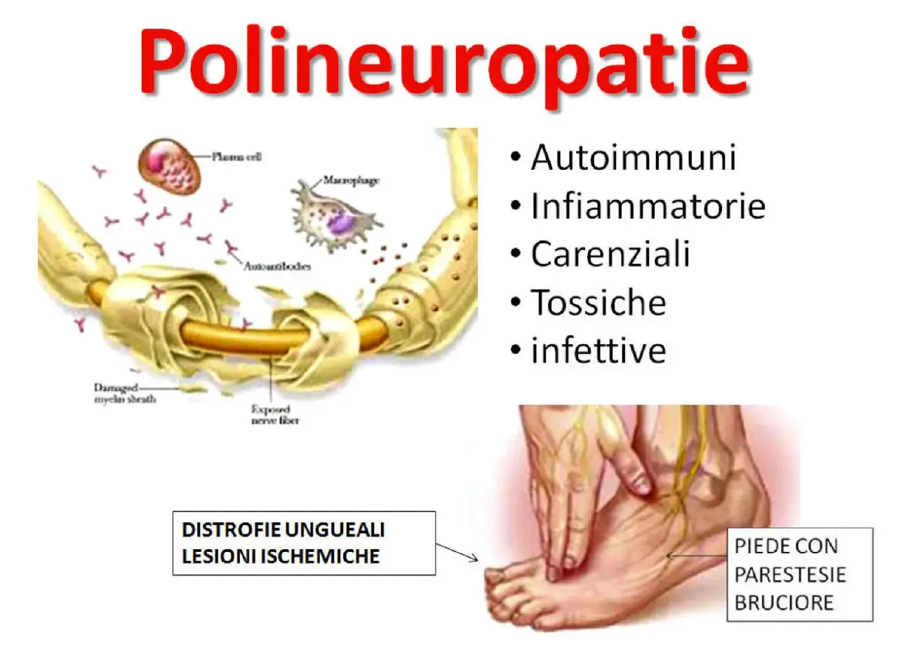 Illustrazione delle polineuropatie: cause autoimmuni, infiammatorie, carenziali, tossiche, infettive. Danno alla guaina mielinica e al nervo. Piede con parestesie.