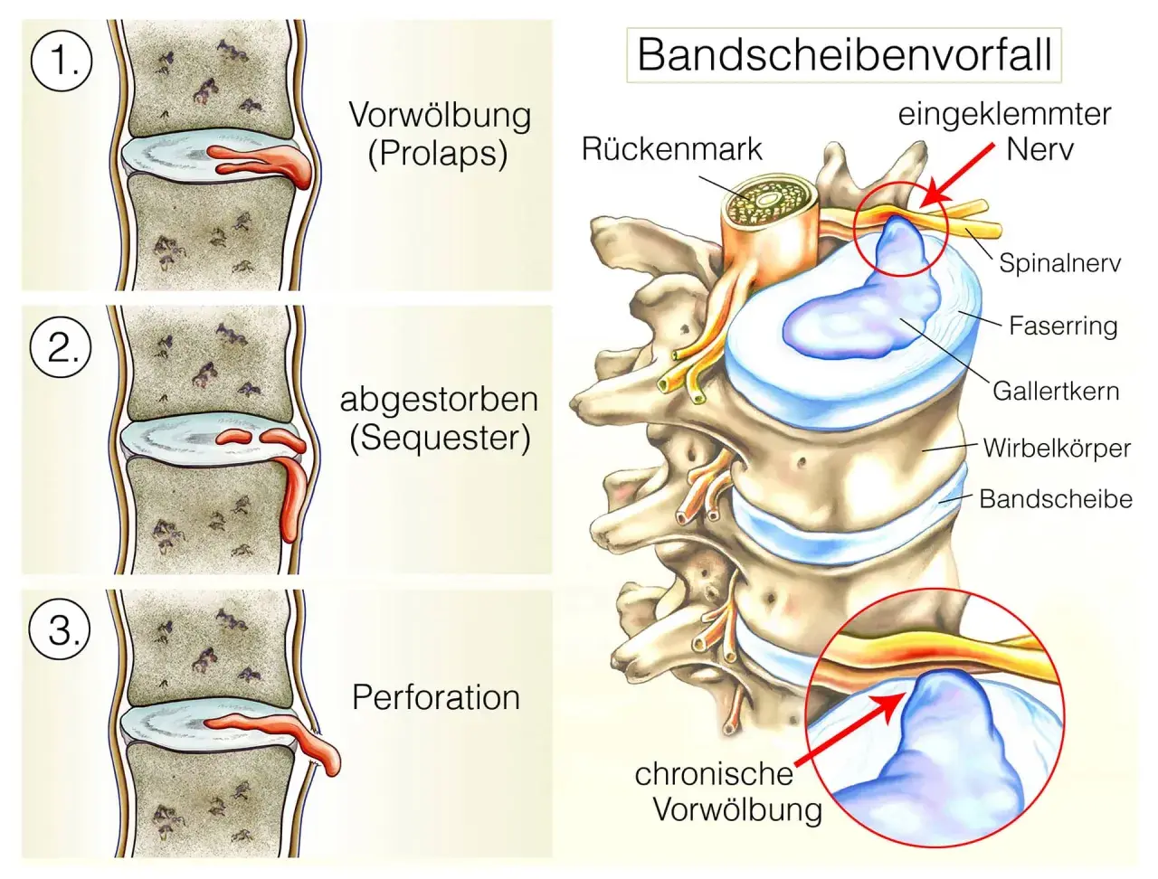 Illustration zeigt die Stadien einer Bandscheibenprotrusion LWS: Vorwölbung, abgestorbener Teil (Sequester) und Perforation, die zu einem eingeklemmten Nerv führen.