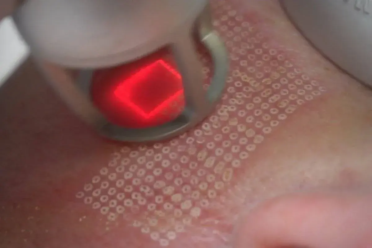 Zabieg laserem frakcyjnym: czy laser frakcyjny jest bezpieczny? Skóra po zabiegu z widocznymi mikrouszkodzeniami.