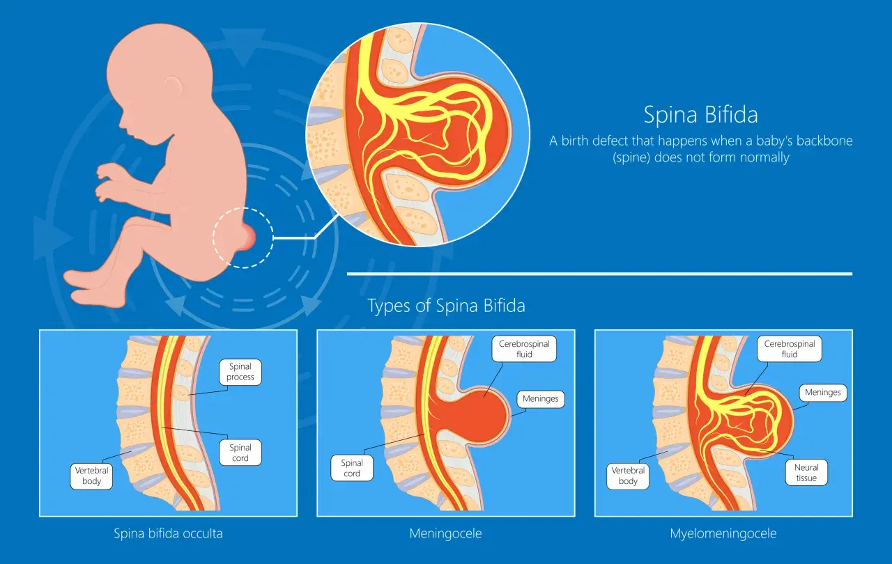 Ilustracja pokazuje wady kręgosłupa u niemowlaka: spina bifida occulta, meningocele i myelomeningocele, gdzie wystający kręgosłup jest widoczny.