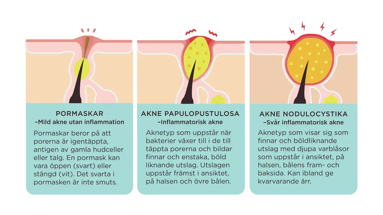 Illustrationer visar olika typer av hormonella utslag: pormaskar, inflammatorisk akne och svår akne med djupa varblåsor.