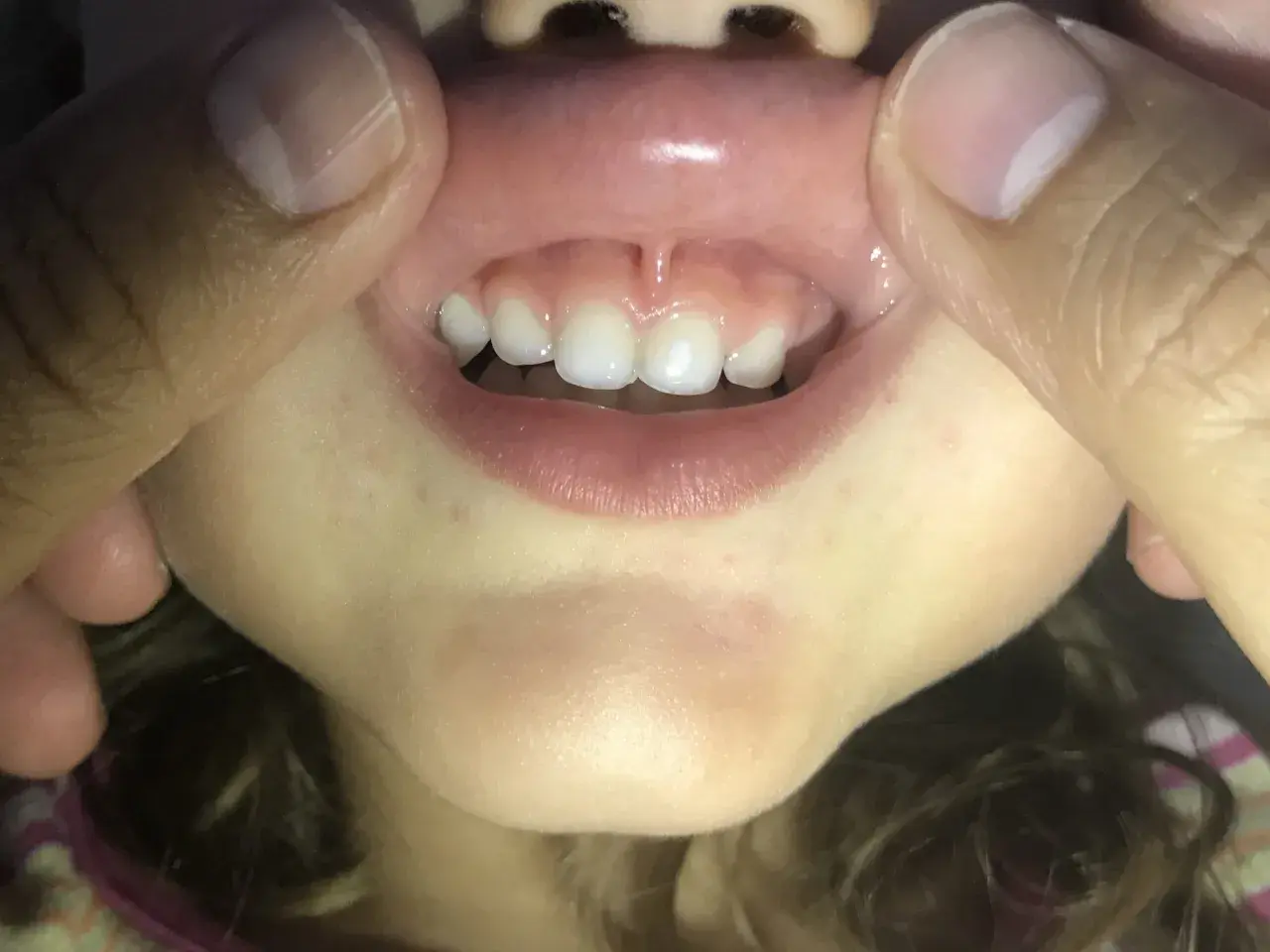 Boca de niño con dientes frontales y el frenillo del labio inferior visible.