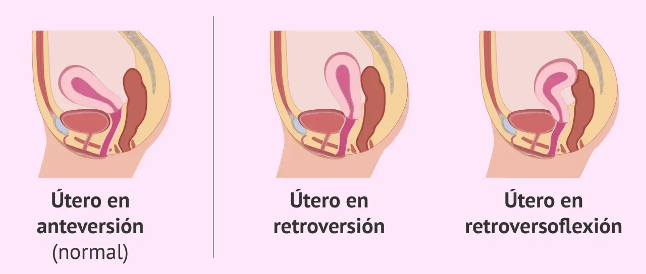Ilustración comparativa de la posición del útero: anteversión (normal), útero en retroversión y útero en retroversoflexión.