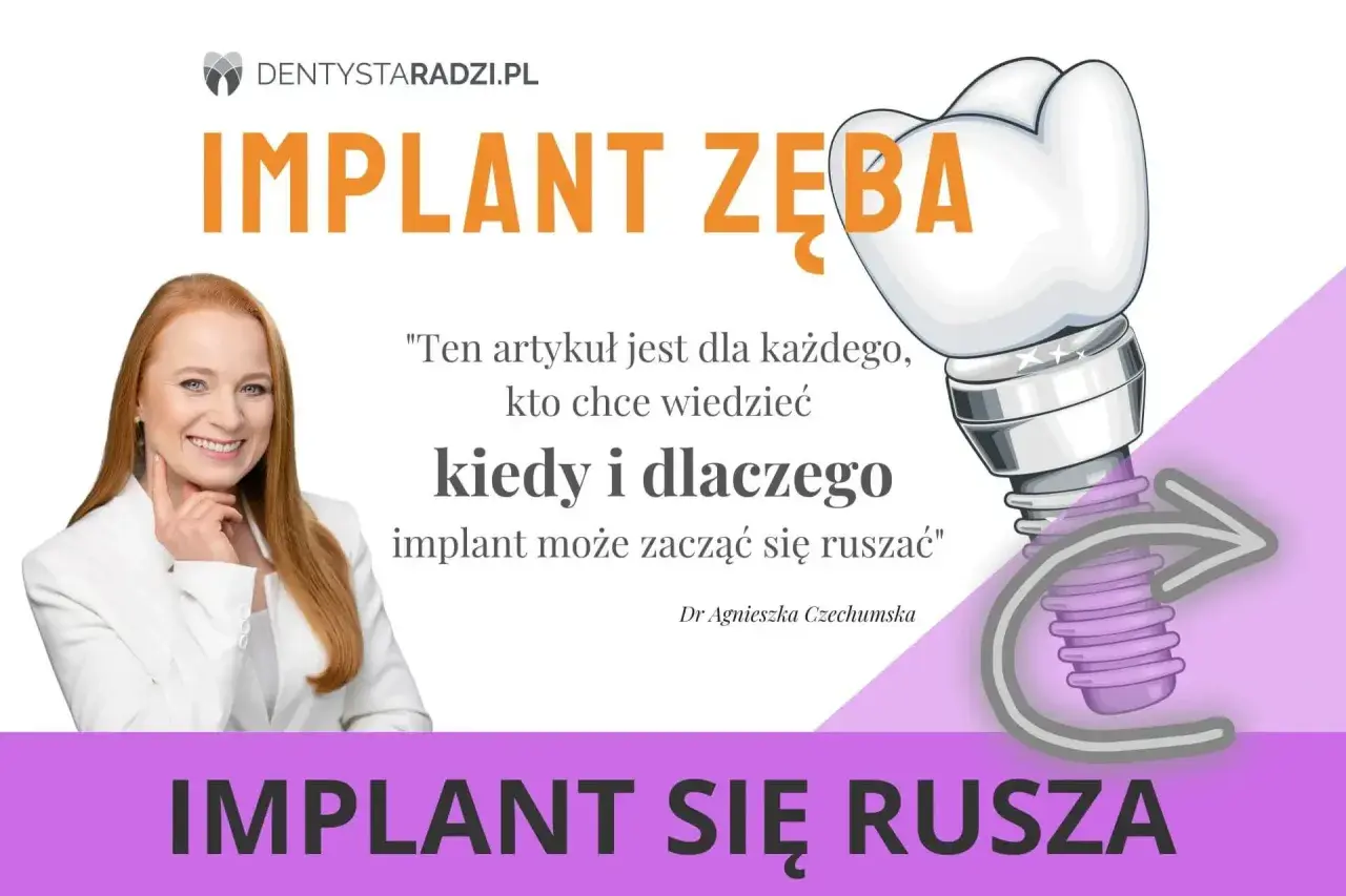 Uśmiechnięta kobieta i grafika implantu zęba. Artykuł wyjaśnia, kiedy i dlaczego ruszający się implant zęba może być problemem.