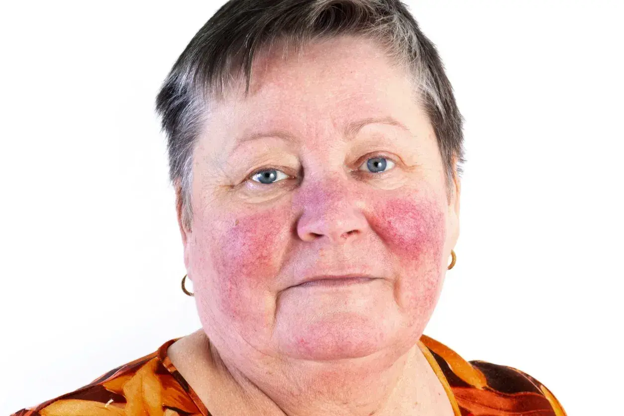 Kvinna med rodnad i ansiktet, troligen rosacea. Hennes hals är också påverkad.