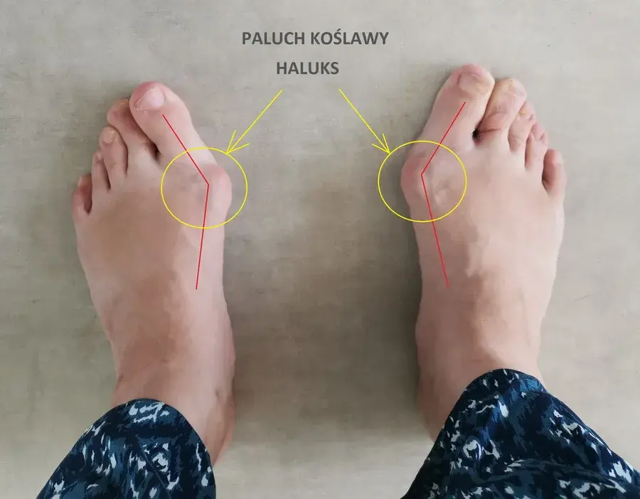 Do jakiego lekarza z haluksami? Ortopeda, podolog, fizjoterapeuta