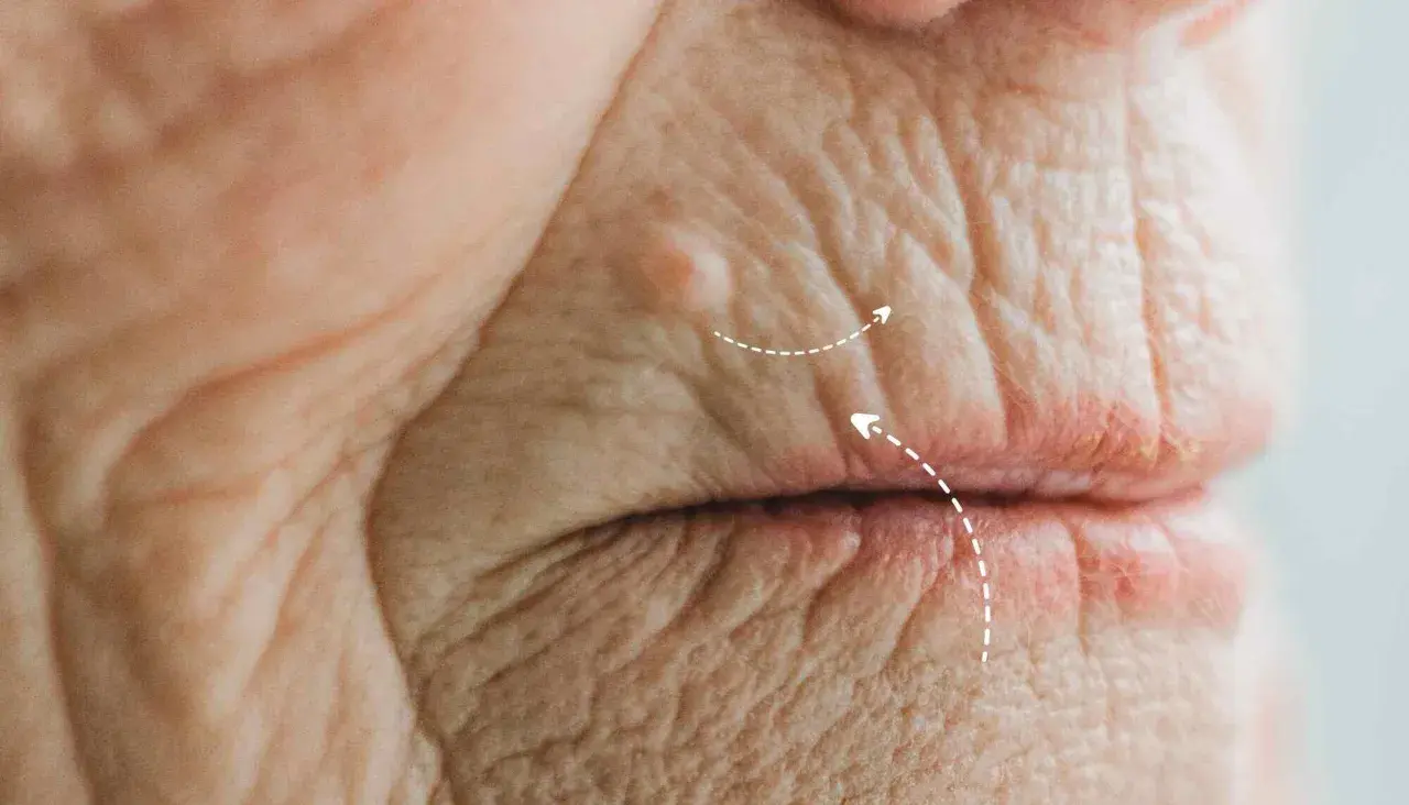Primer plano de arrugas en el labio superior, mostrando la textura de la piel madura y un pequeño bulto.