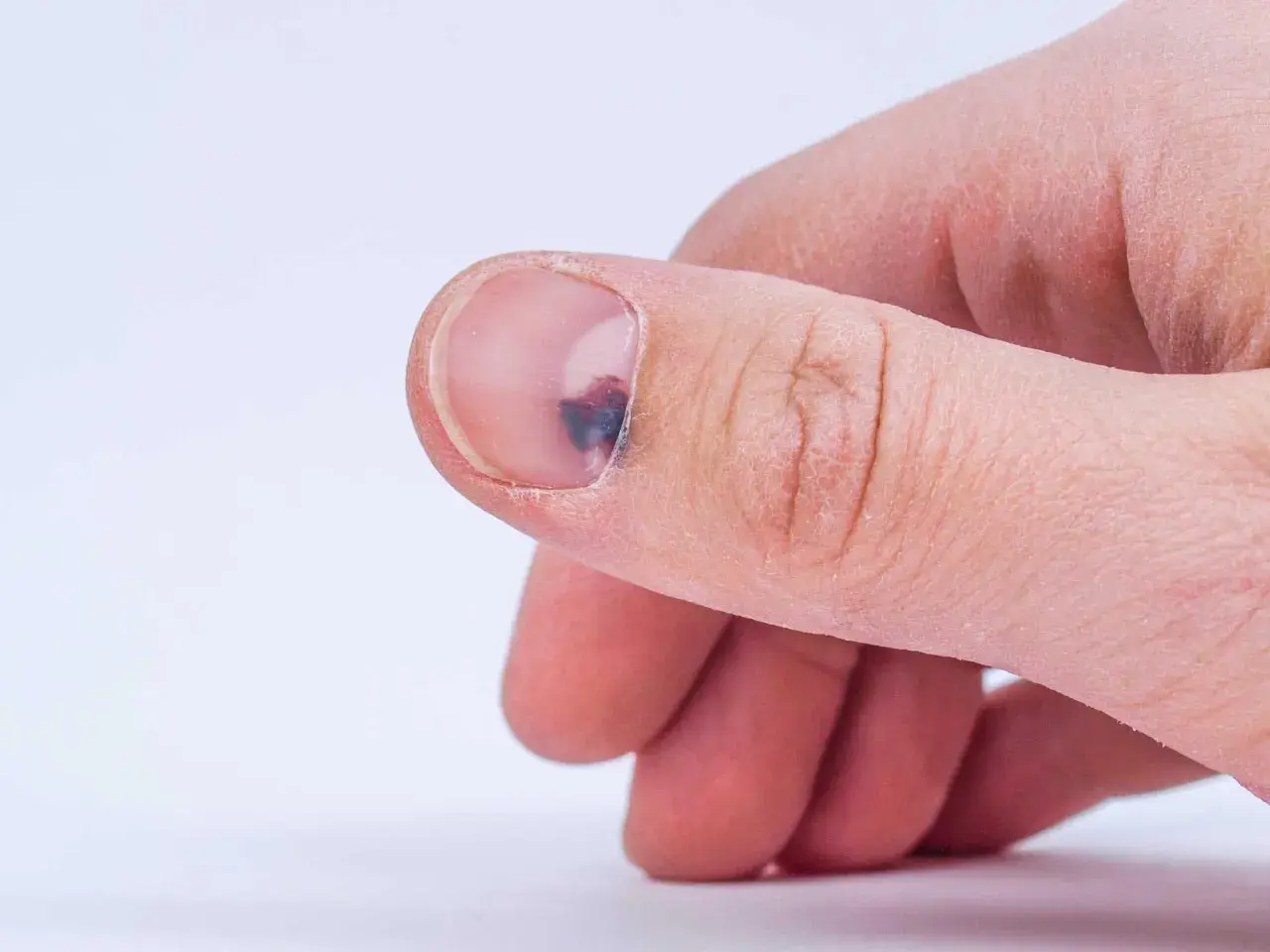Ein blauer Fleck unter dem Fingernagel, vielleicht durch einen Stoß. Hausmittel können bei solchen Blutergüssen helfen.