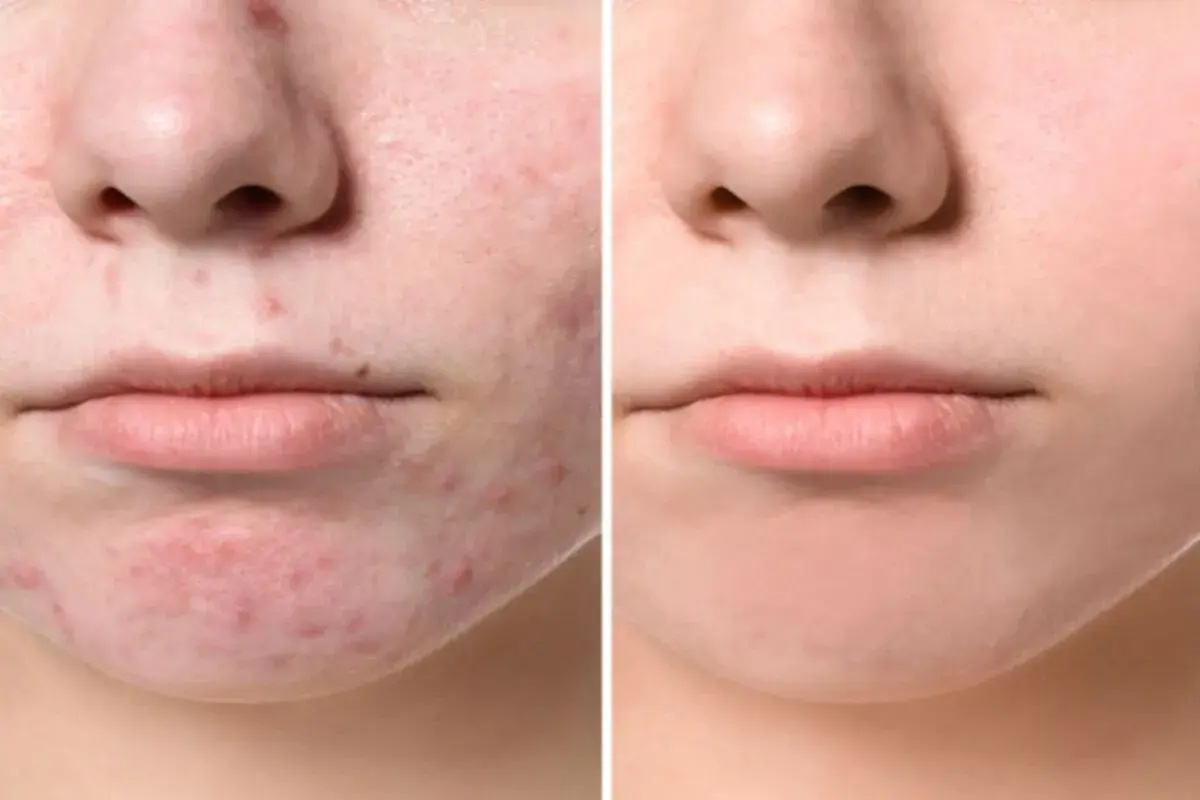 Confronto tra pelle con acne giovanile e pelle trattata, mostrando l'efficacia dei rimedi della nonna.