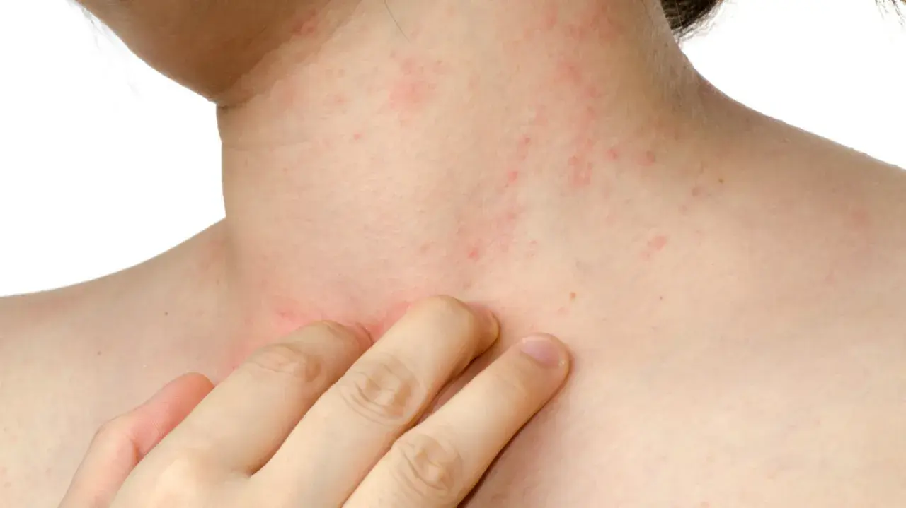 Pelle arrossata e irritata sul collo e sul petto, con piccole macchie rosse, sintomo di dermatite da stress.