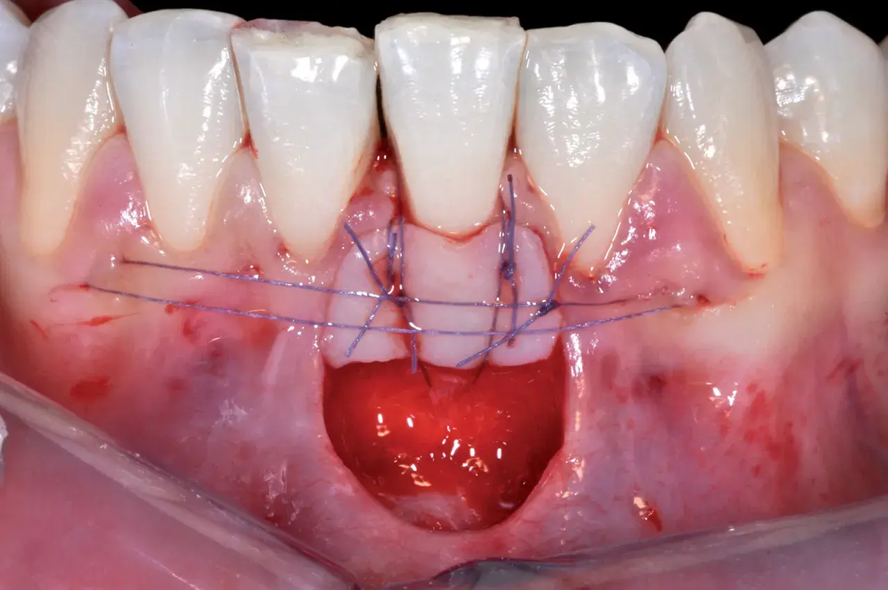 Primo piano di un innesto gengivale con suture viola che fissano il tessuto.