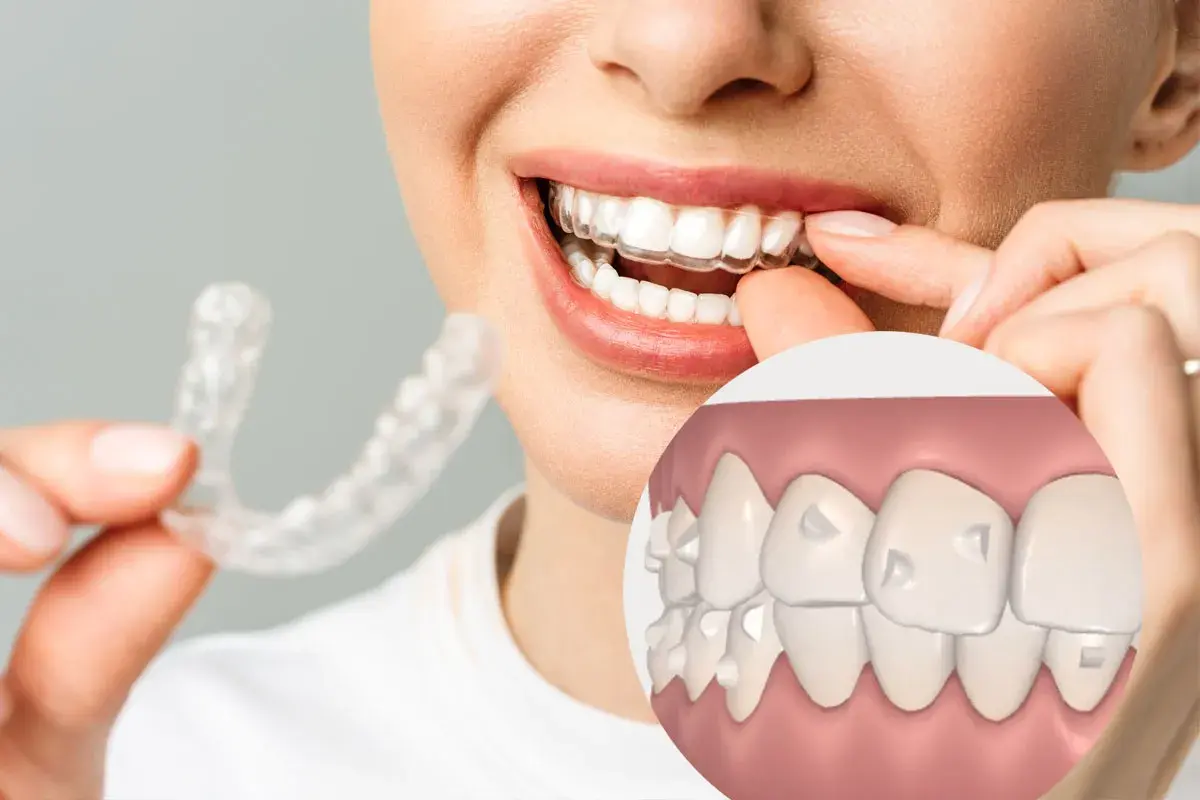Una mujer sonríe mientras se coloca un alineador transparente. Un primer plano muestra dientes con pequeños ataches, revelando para que sirven los ataches: guiar el movimiento dental.