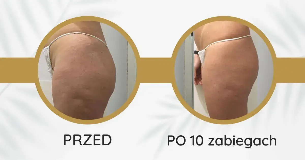 Endermologia: ile cm mniej? Realne efekty i sekrety sukcesu