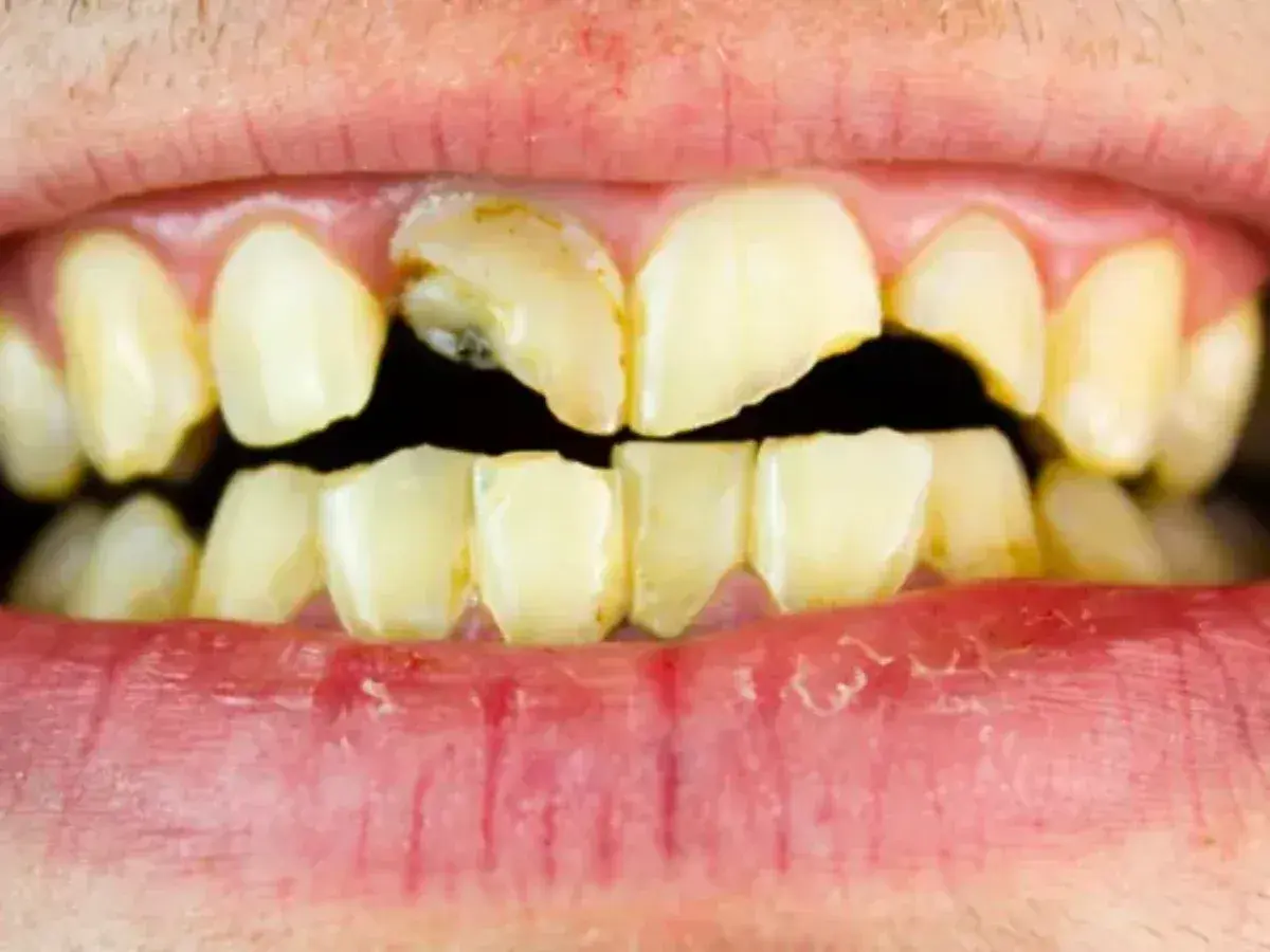 Dientes amarillentos y rotos, con caries visibles. Un triste reflejo de los dientes de drogadicto, que muestran el devastador efecto de las adicciones en la salud bucal.