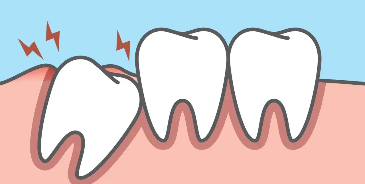 Dente incapsulato che fa male, con fulmini rossi che indicano dolore e gengiva infiammata.