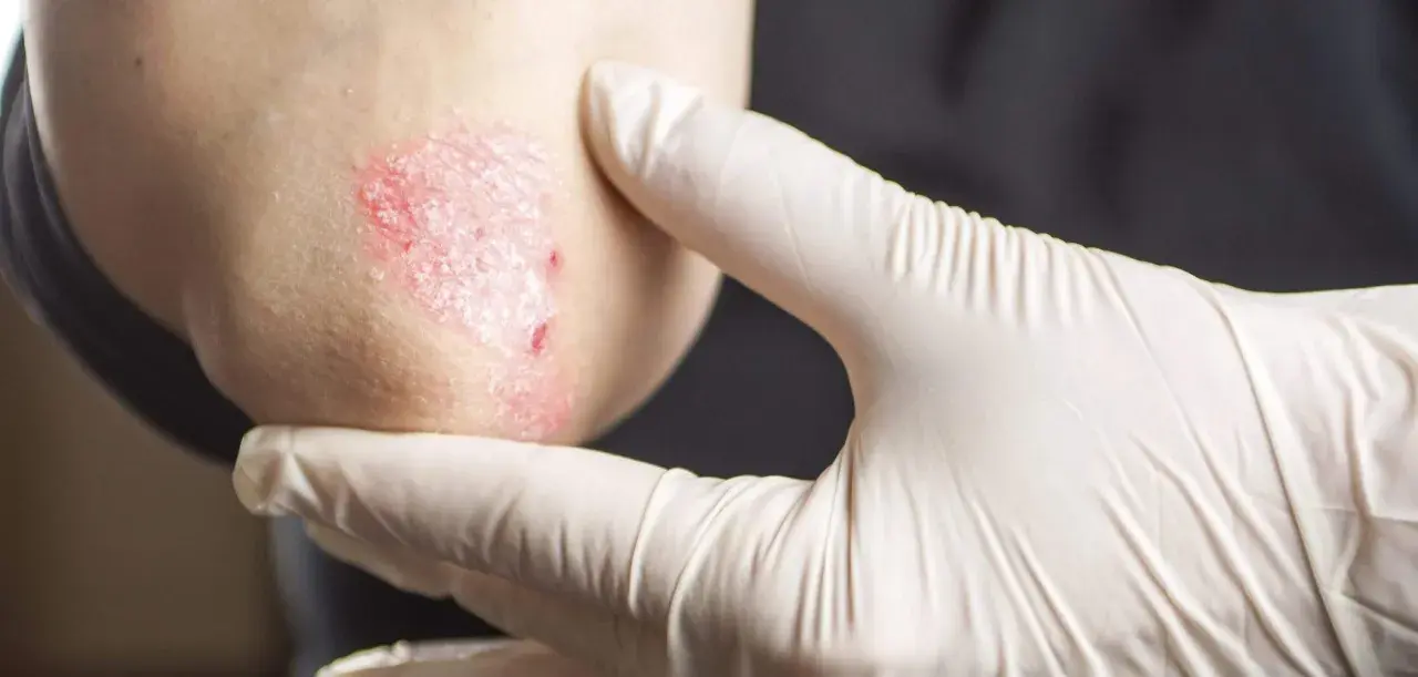 Gomito di un bambino con psoriasi, esaminato da una mano guantata.