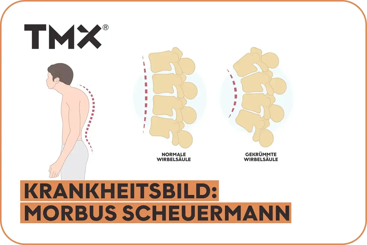 Vergleich einer normalen und gekrümmten Wirbelsäule, die das Krankheitsbild Morbus Scheuermann im Endstadium illustriert.