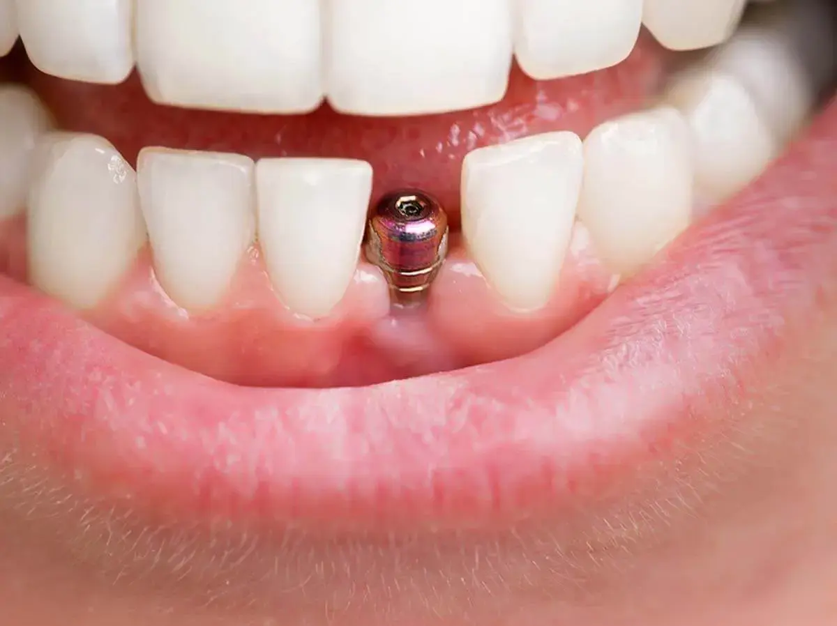 Metalowy implant zęba wystaje z dziąsła między białymi zębami, gotowy na odbudowę.
