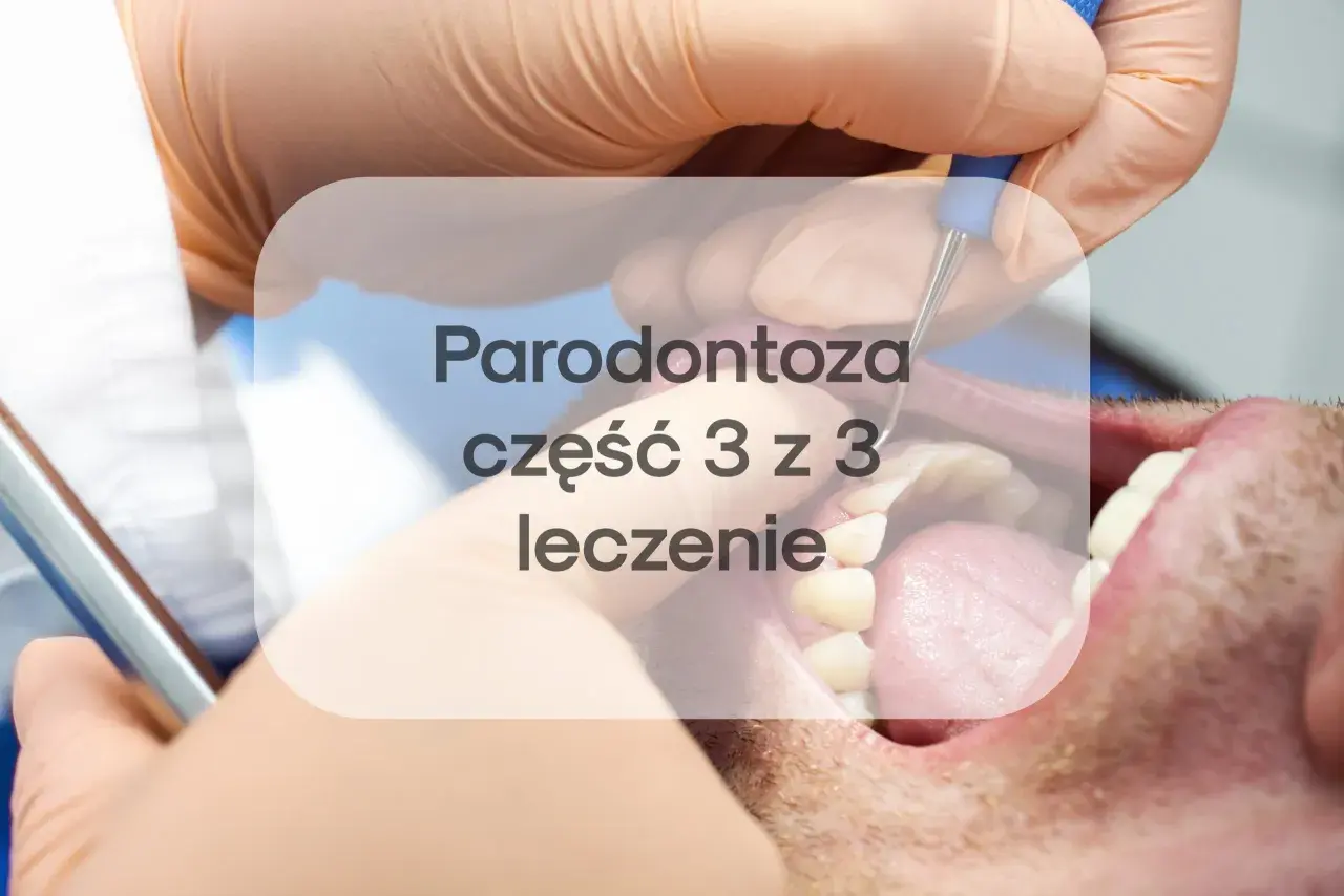 Leczenie paradontozy laserem to nowoczesna metoda. Sprawdź, jaka jest laserowe leczenie paradontozy cena i jak przebiega zabieg.