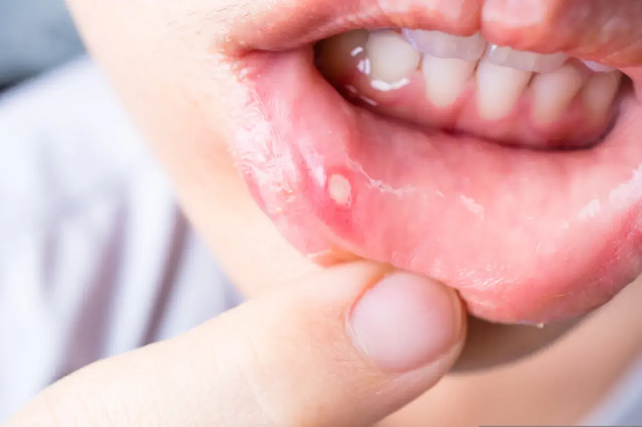 Nahaufnahme einer Lippe mit einem weißen, wunden Fleck. Ein Finger berührt die betroffene Stelle, die auf wunden im mund hausmittel hinweist.