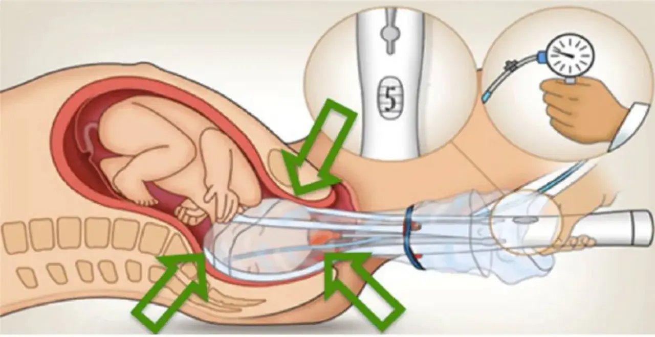 Illustration d'un bébé dans l'utérus, avec une ventouse d'accouchement appliquée sur sa tête. Un manomètre indique la pression.