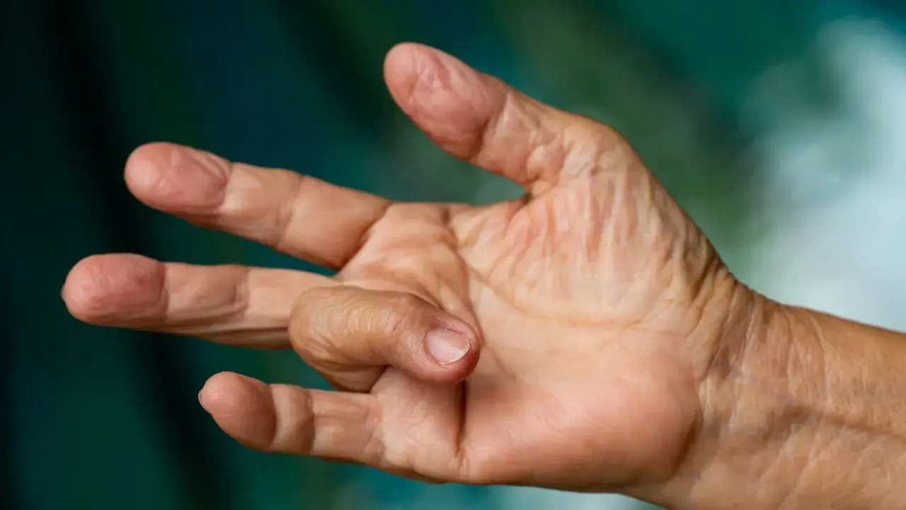 Nahaufnahme einer Hand, bei der ein Finger in einer gekrümmten Position verharrt. Dies kann ein Symptom für einen Schnappfinger sein, dessen Ursache oft eine Entzündung der Sehnenscheide ist.