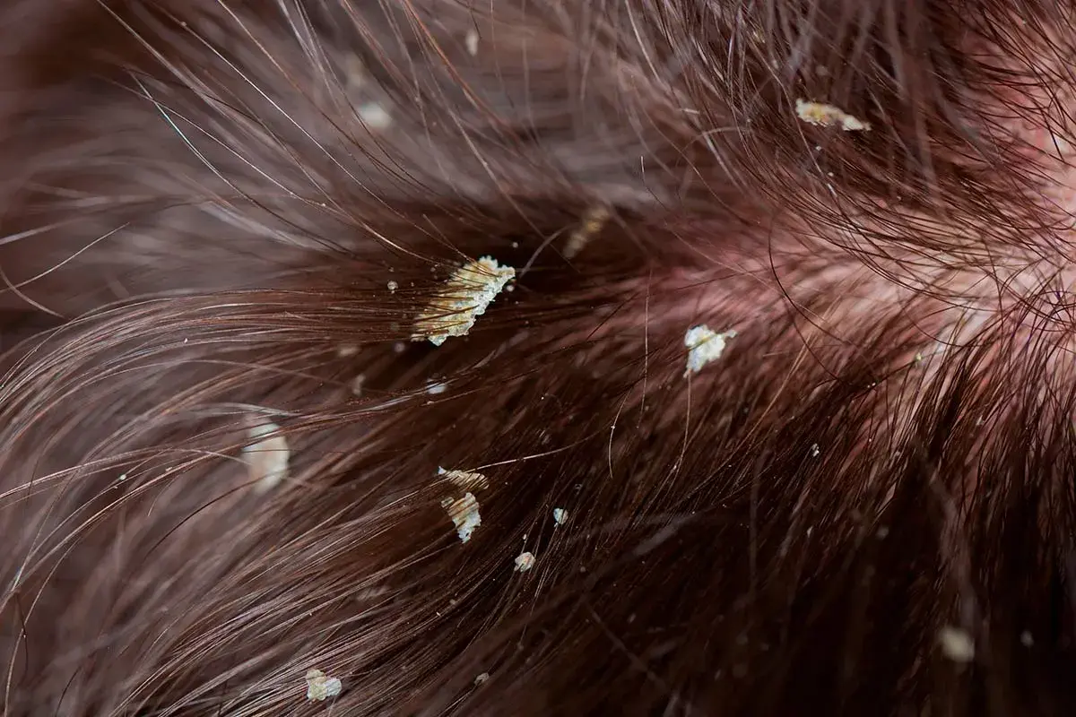 Primer plano de cabello castaño con escamas blancas visibles, indicando descamación del cuero cabelludo.