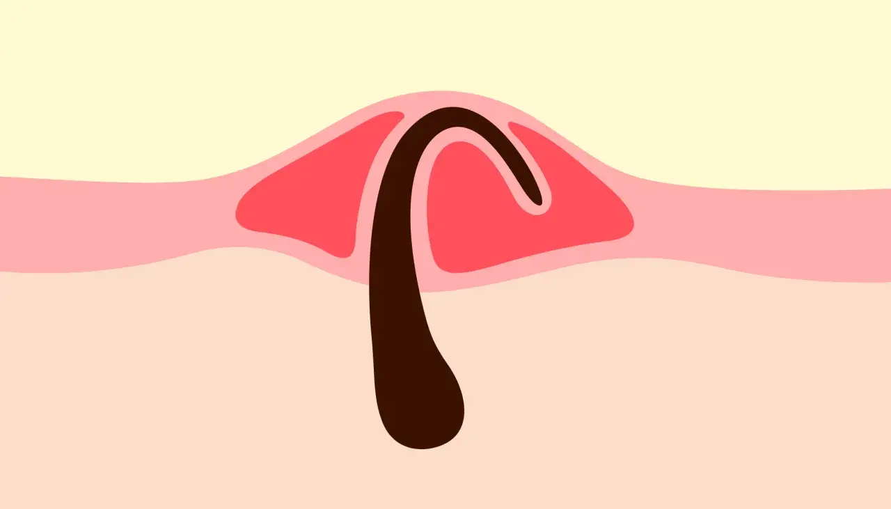 Illustration d'un bouton, montrant un poil pubien courbé sous la peau.