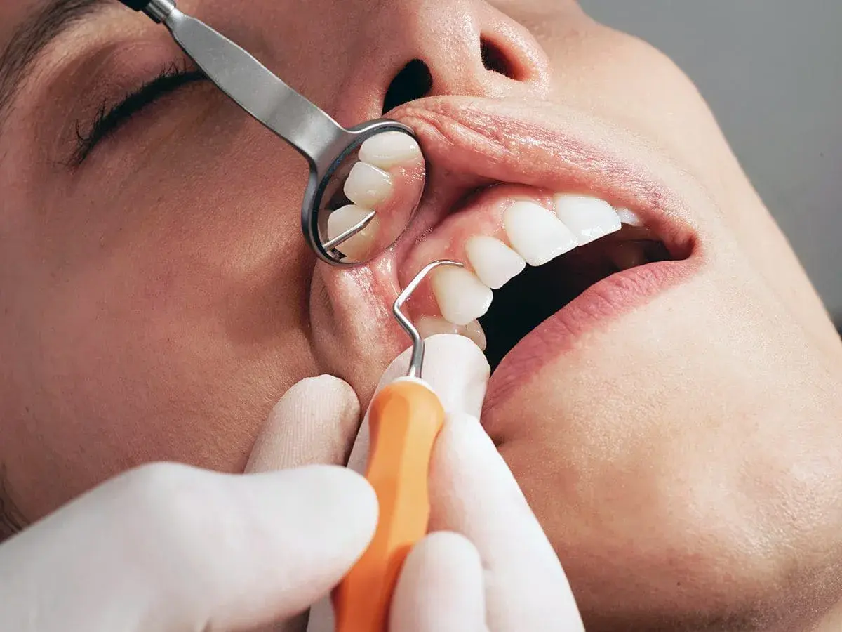 Dettaglio di un intervento di curettage gengivale, con strumento dentale che pulisce la zona tra dente e gengiva.