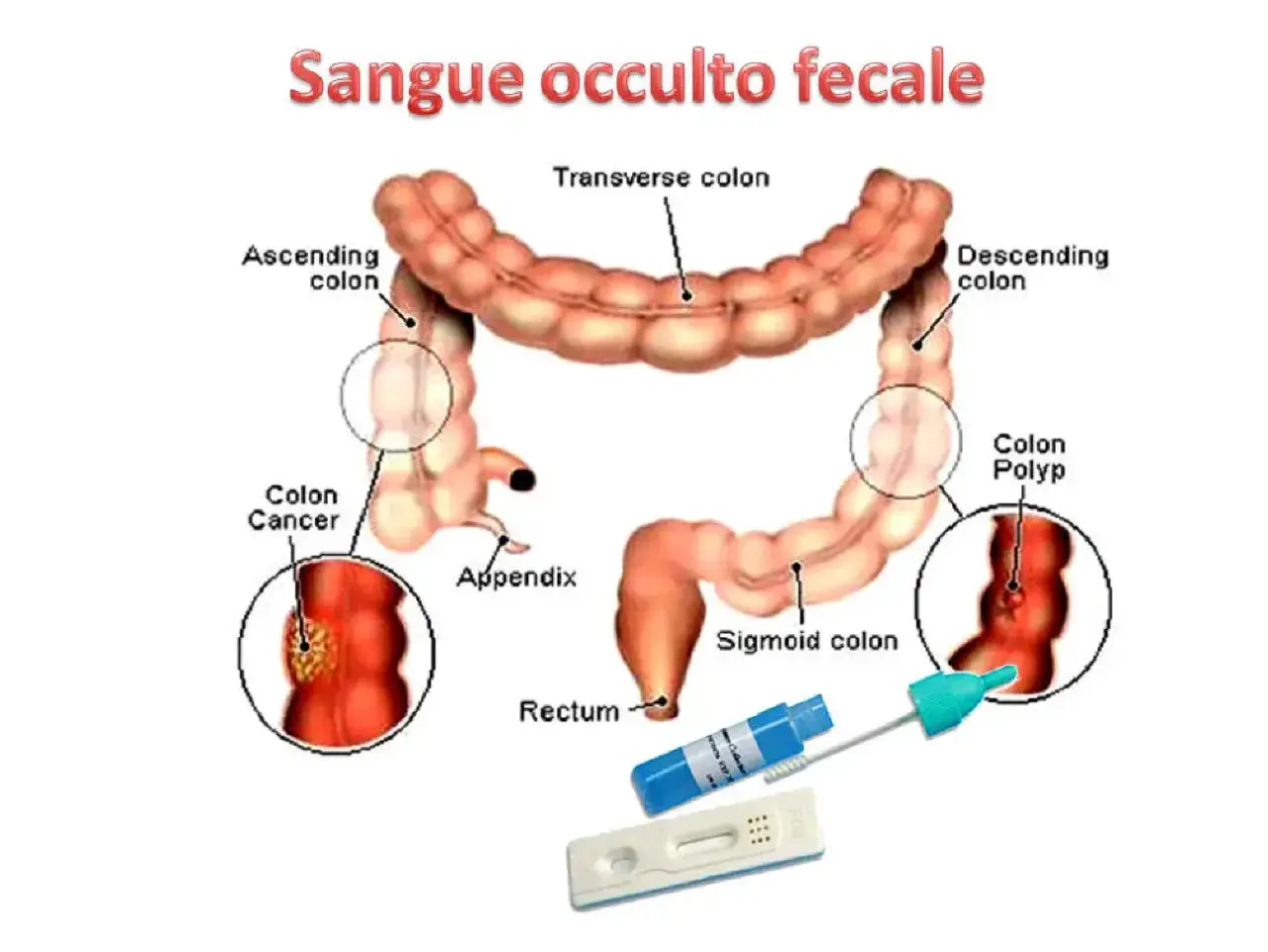 Illustrazione del colon con indicazioni su cancro, polipi e test per sangue occulto nelle feci.