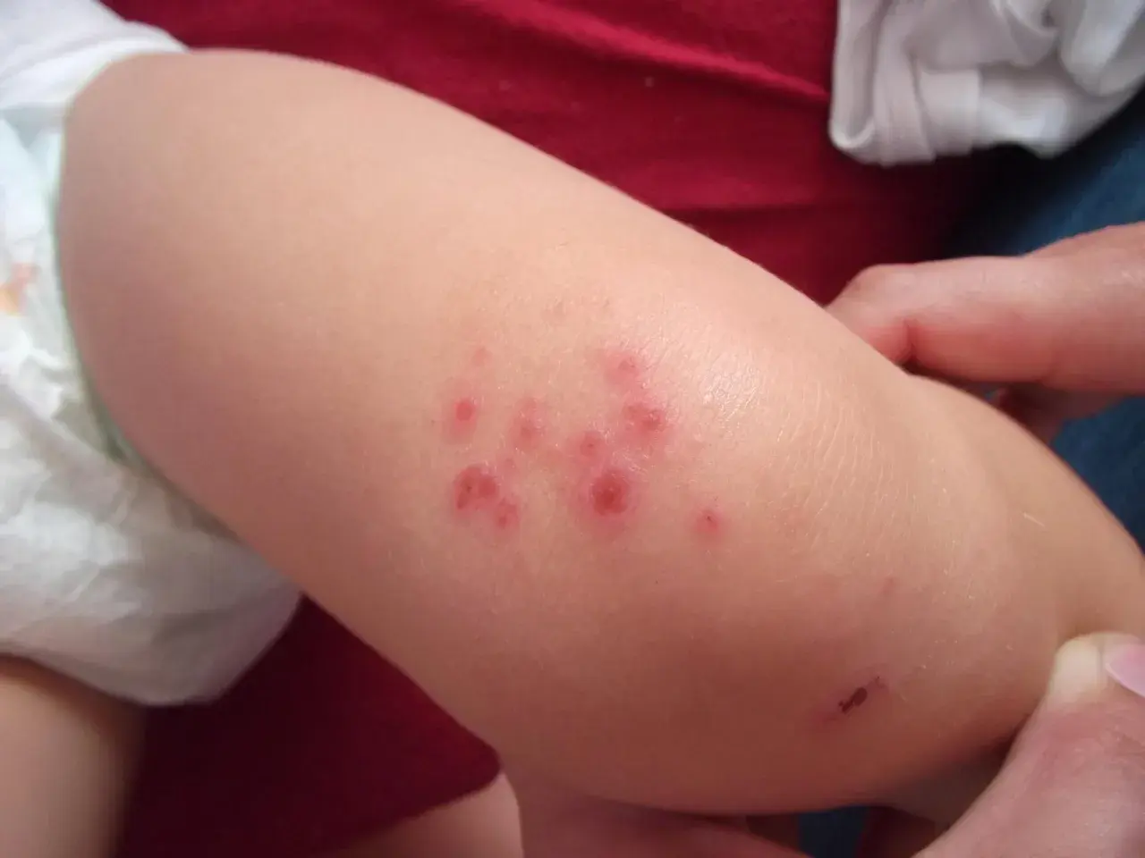 Lesioni cutanee rosse e pruriginose su un braccio di bambino, indicative di impetigine.