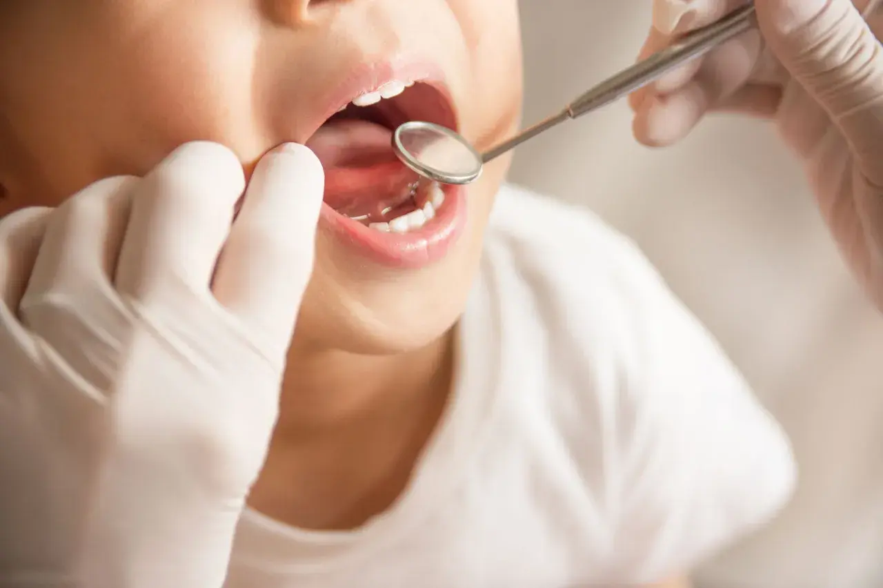 Bambino con bocca aperta esaminata da un dentista con specchietto. Si valuta la possibile ipomineralizzazione dello smalto.