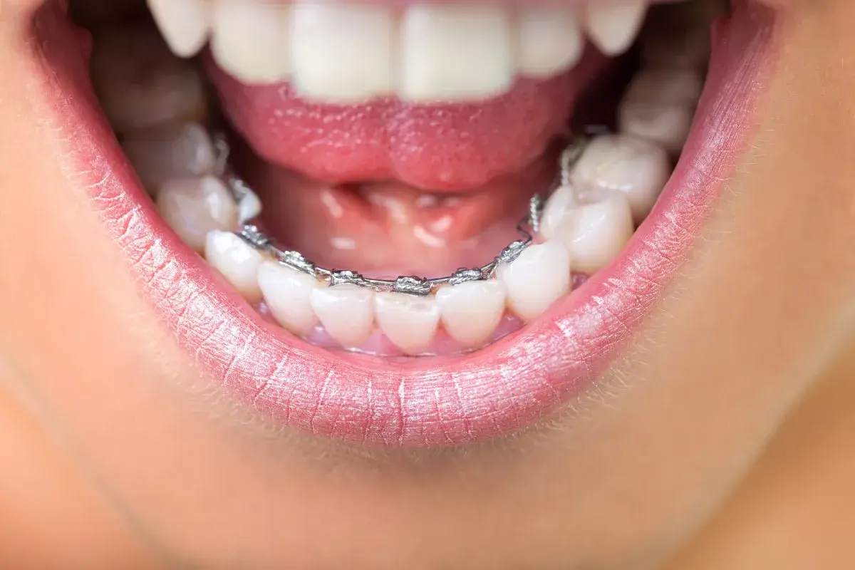 Primo piano di una bocca con apparecchio ortodontico. Un apparecchio per rieducare la lingua aiuta a correggere la posizione dei denti.