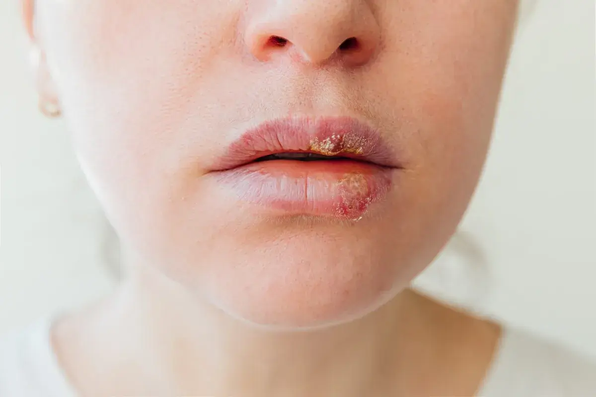 Labbra con lesioni erpetiche. Le vescicole e le croste indicano la fase attiva, ma quanto dura l'herpes?