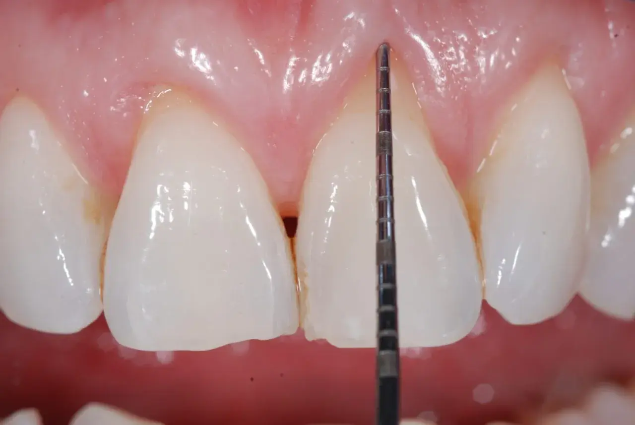 Misurazione della profondità gengivale con sonda parodontale. La recessione gengivale è un problema da non sottovalutare.