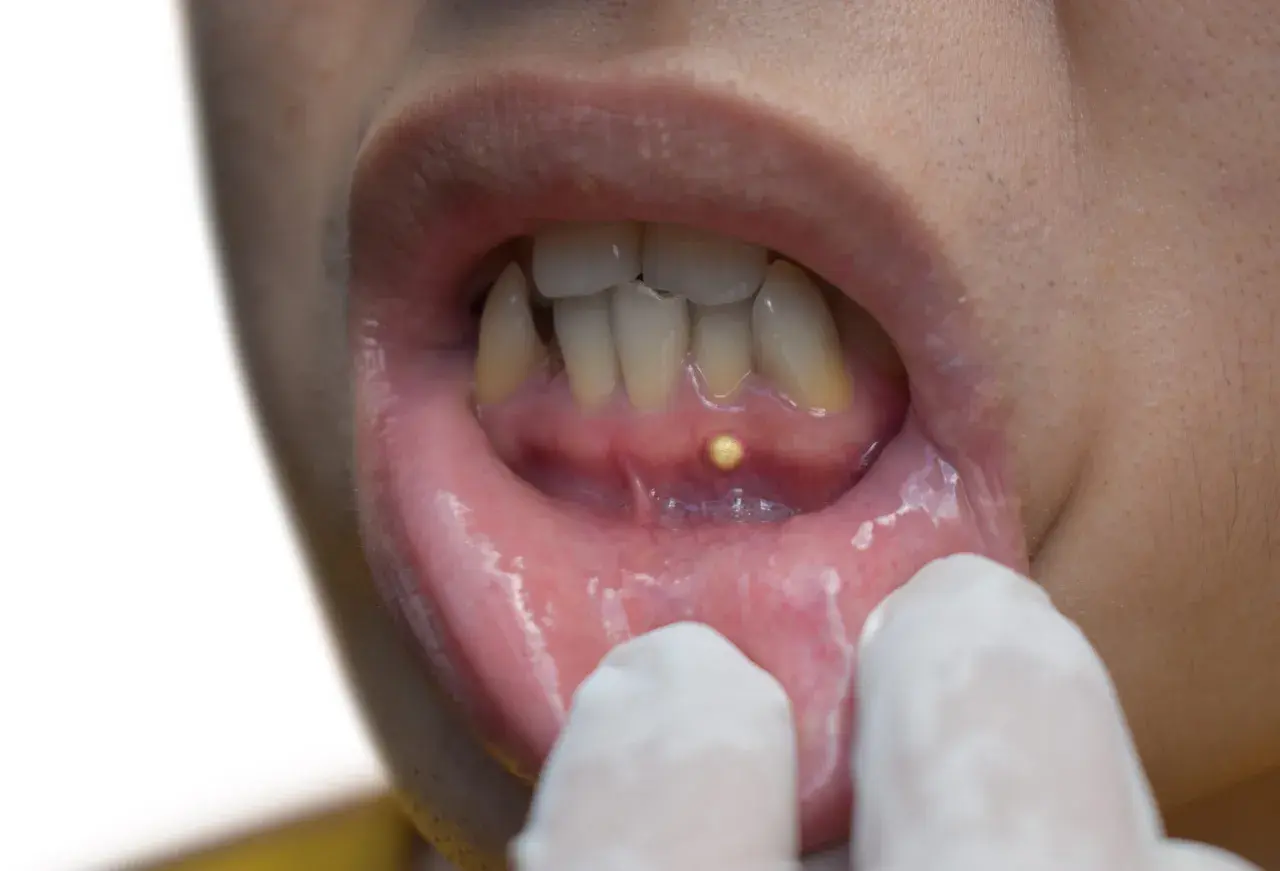 Pequeña protuberancia amarilla en la encía, posiblemente un quiste gingival, examinada con guantes.