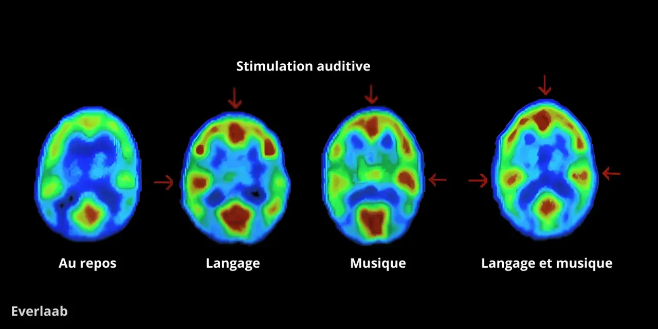 Imagerie cérébrale montrant l'activité lors du repos, du langage, de la musique et des deux. La musique révèle une zone sensible en musique.