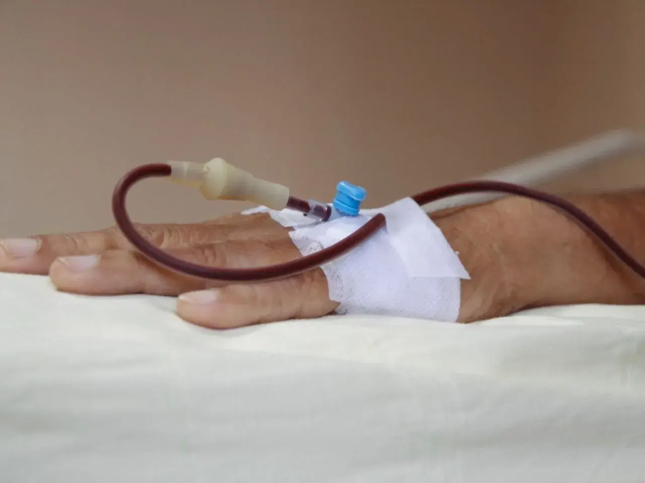 Dłoń pacjenta z założonym wenflonem i podłączoną czerwoną rurką do transfuzji.