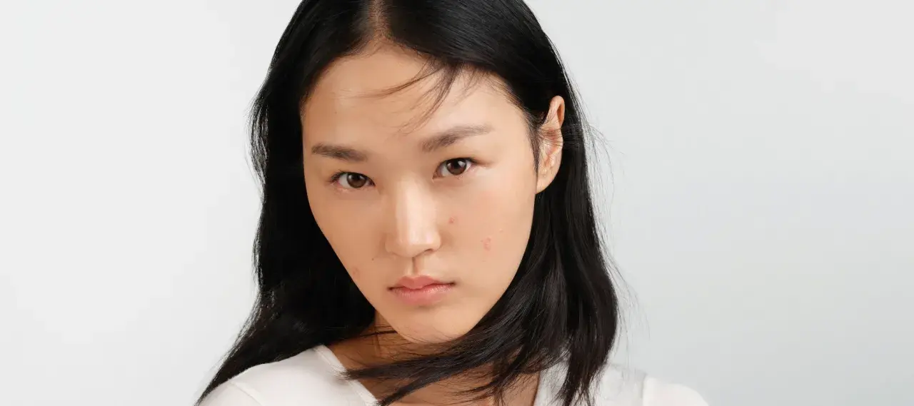 Jeune femme au visage marqué par des imperfections. Elle cherche des solutions sur que faire contre la peau grasse.