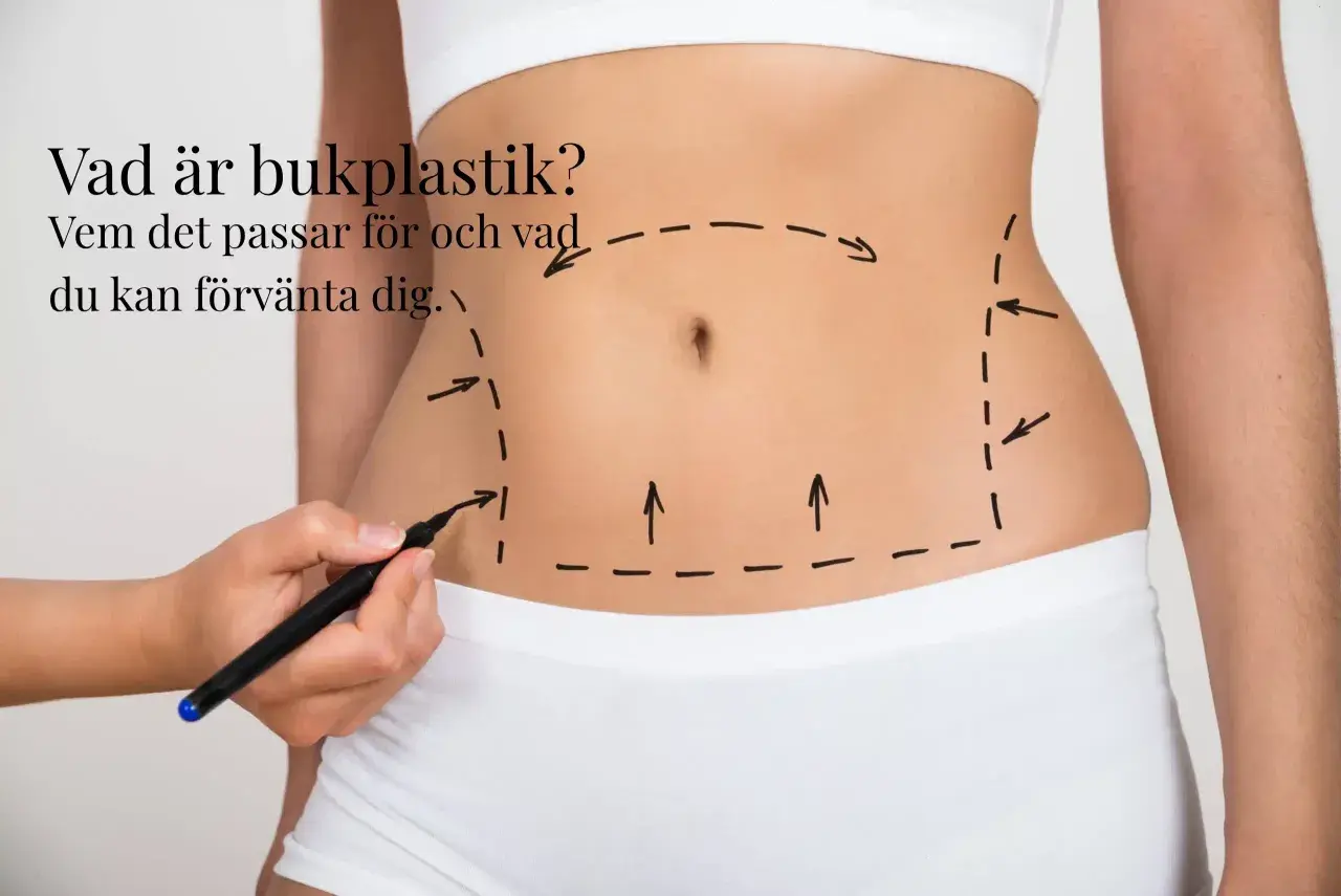 En hand markerar med penna en linje runt en mage, som visar området för en bukplastik. Texten frågar "Vad är bukplastik?".
