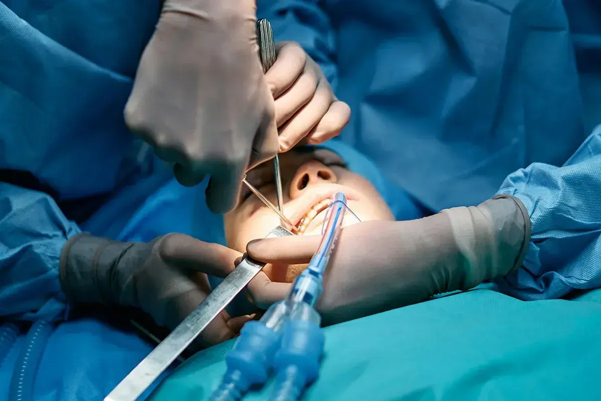 Procedimiento dental con anestesia general para extracción de muelas del juicio. Cirujanos operan la boca de un paciente.
