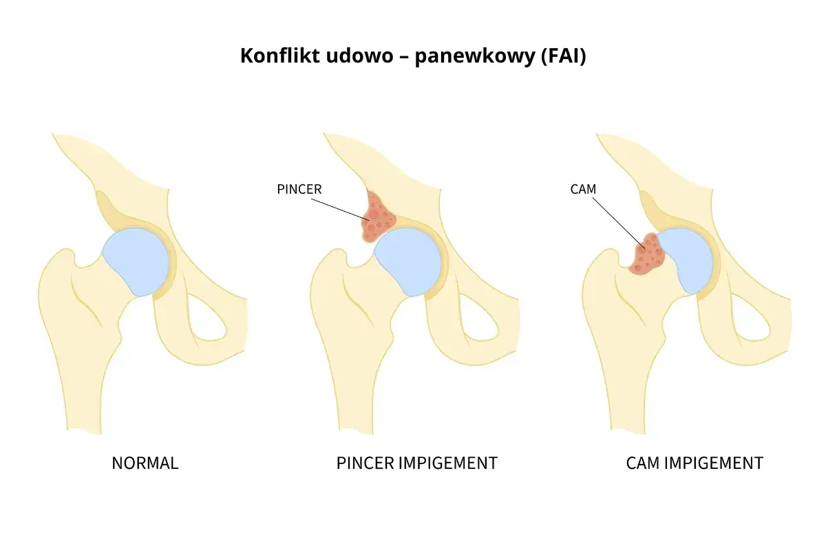 Ilustracja porównująca prawidłowe biodro z biodrem z konfliktem typu PINCER i CAM.