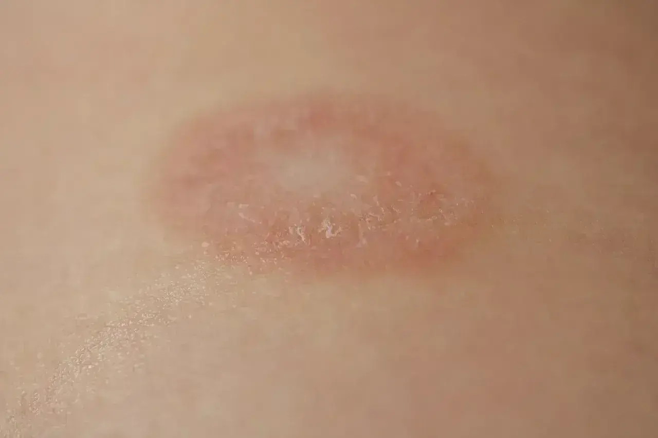 Okrągła, łuszcząca się zmiana skórna z zaczerwienieniem na obrzeżach, przypominająca łupież Gilberta.
