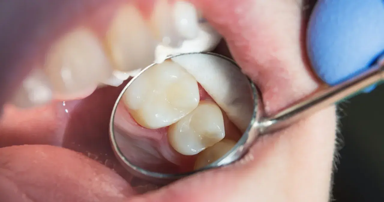 Stomatolog bada zęby, szukając próchnicy ukrytej. Widać fragment jamy ustnej, zęby i lusterko dentystyczne.