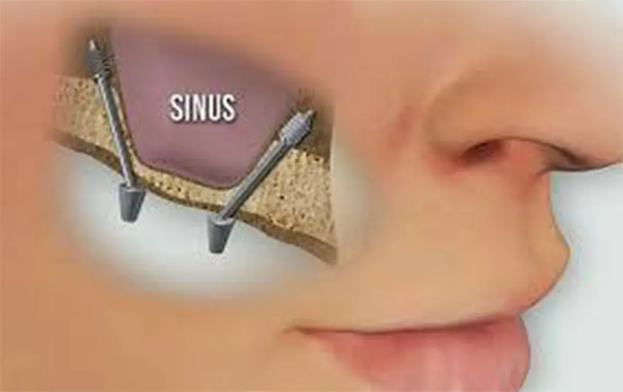 Illustrazione di un sinus lift: due impianti dentali inseriti nell'osso mascellare superiore, vicino al seno mascellare.
