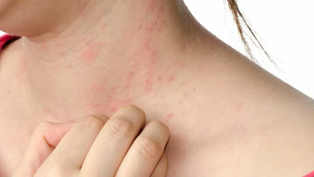 Piel irritada con enrojecimiento y pequeños bultos, indicando posible reacción a ácaros, alergia en la piel.