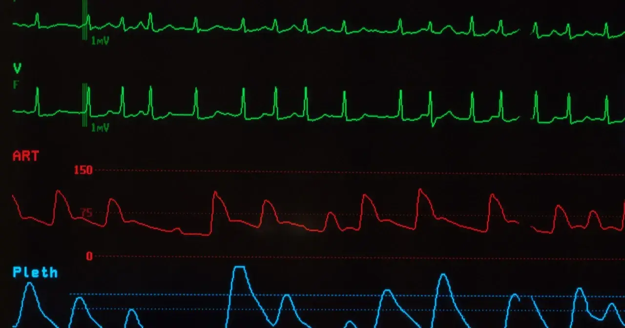 Monitor EKG pokazuje nieregularne fale, co może sugerować migotanie przedsionków. Długość życia z migotaniem przedsionków zależy od wielu czynników.