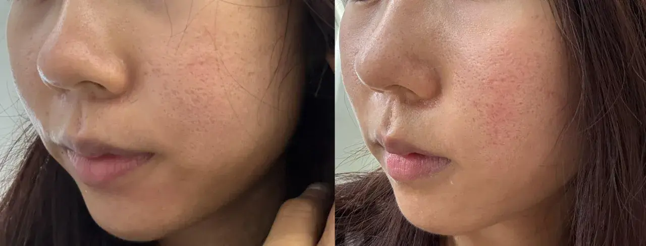 Split image showing a woman's cheek and nose area before and after fractional laser treatment, highlighting changes in skin texture and pore appearance.