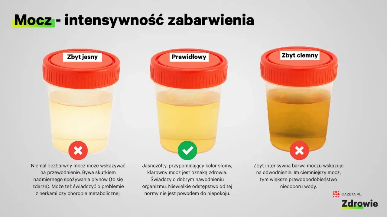 Obraz pokazuje trzy pojemniki z moczem o różnym zabarwieniu: zbyt jasnym, prawidłowym i zbyt ciemnym. Zbyt jasny mocz może wskazywać na przewodnienie lub problemy z nerkami. Prawidłowy mocz jest jasnożółty i świadczy o dobrym nawodnieniu. Zbyt ciemny m...
