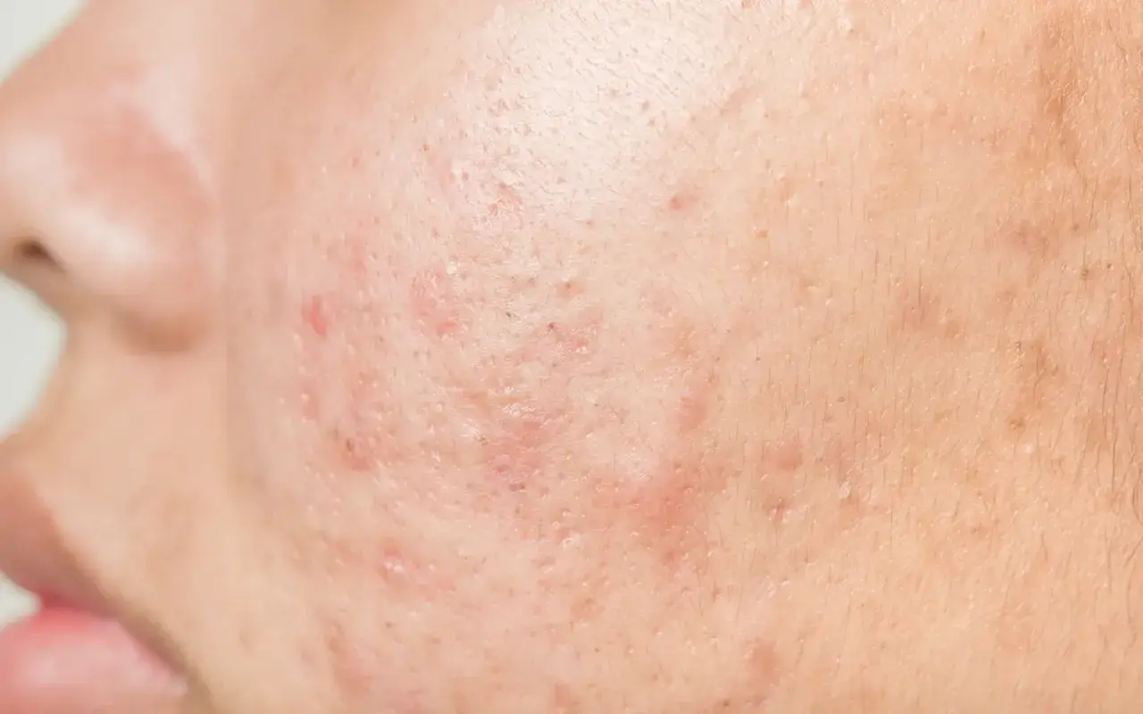 Gros plan sur une peau présentant des rougeurs et des imperfections, illustrant la cause de l'acné sur le visage.